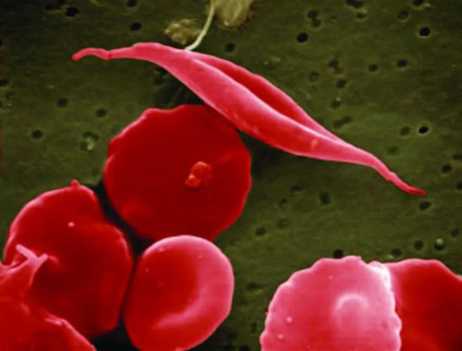 Microscopic image of blood cells, showcasing the contrast between typical, round red blood cells, and the crescent shape caused by sickle cell disease.
